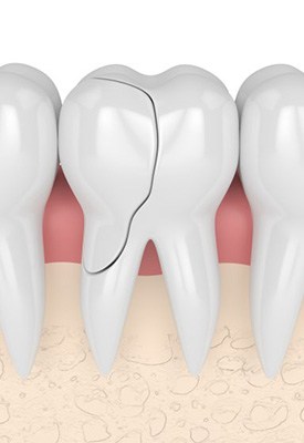 Digital image of a cracked tooth