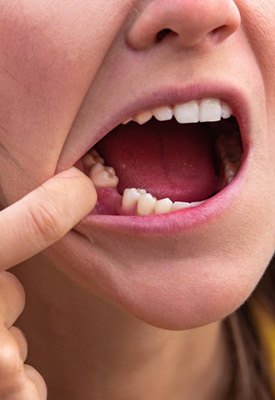 Woman pulling back her lip to reveal a missing tooth