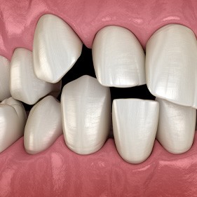 Illustration of spaced-out teeth