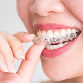 Closeup of patient putting on clear aligner