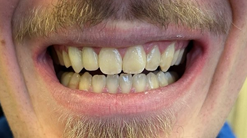 corrected chipped front teeth after