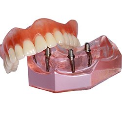 Sample set of all-on-4 dentures with a translucent pink model base