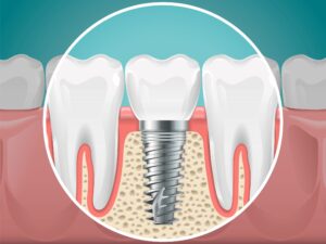 Diagram of a dental implant embedded next to teeth