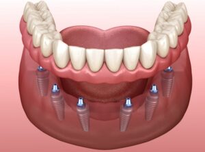 illustration of implant dentures