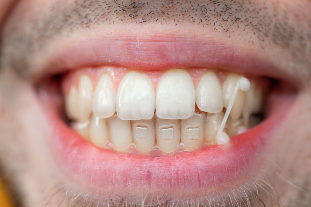 Man showing Invisalign attachments on his teeth